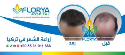  كيفية إجراء عملية زراعة الشعر في تركيا ملف شامل ومتكامل P_9382jt531